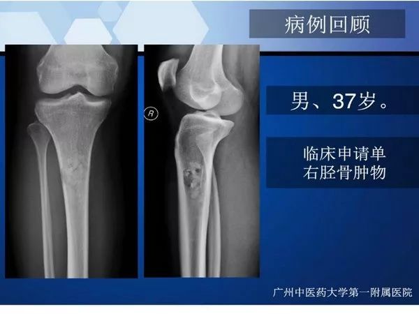 【PPT】不同部位软骨瘤影像诊断
