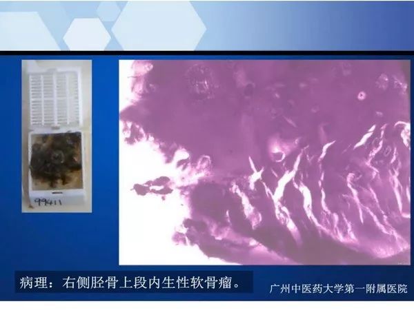 【PPT】不同部位软骨瘤影像诊断