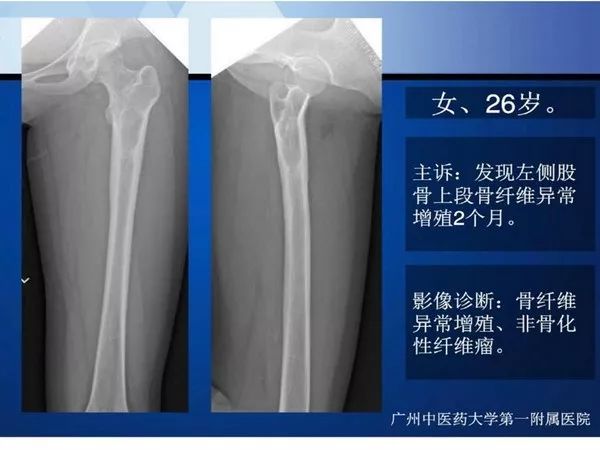 【PPT】不同部位软骨瘤影像诊断