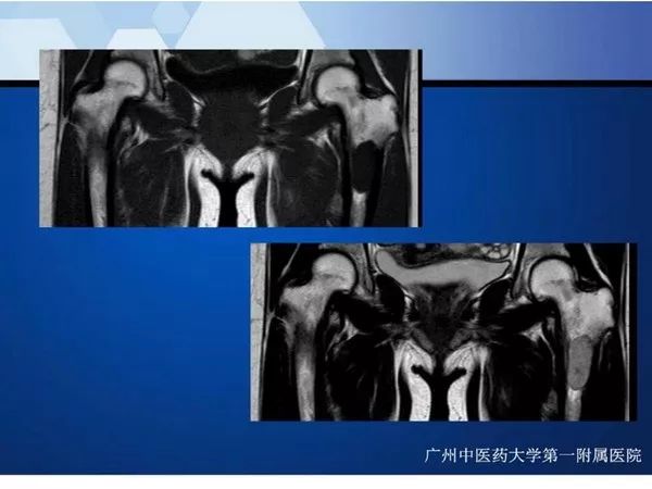 【PPT】不同部位软骨瘤影像诊断