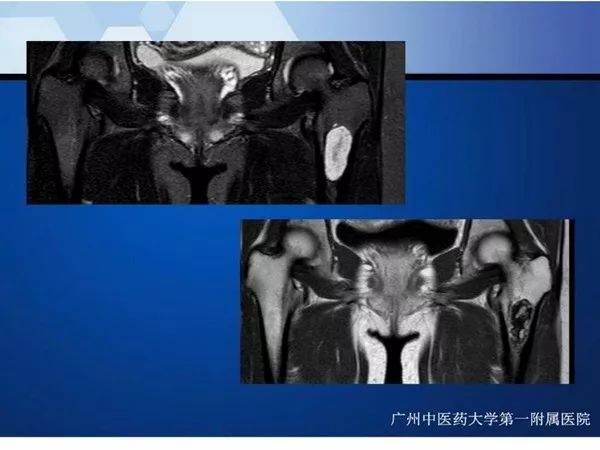 【PPT】不同部位软骨瘤影像诊断