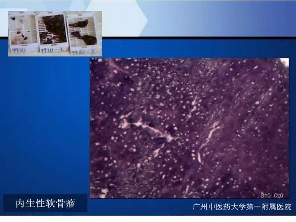 【PPT】不同部位软骨瘤影像诊断