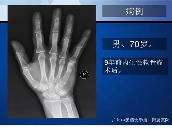 【PPT】不同部位软骨瘤影像诊断