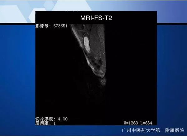 【PPT】不同部位软骨瘤影像诊断