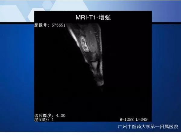 【PPT】不同部位软骨瘤影像诊断