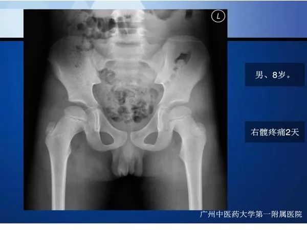 【PPT】不同部位软骨瘤影像诊断
