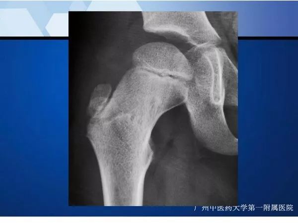 【PPT】不同部位软骨瘤影像诊断