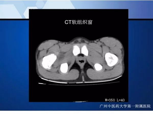 【PPT】不同部位软骨瘤影像诊断