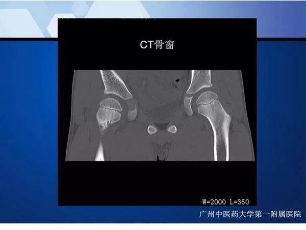 【PPT】不同部位软骨瘤影像诊断