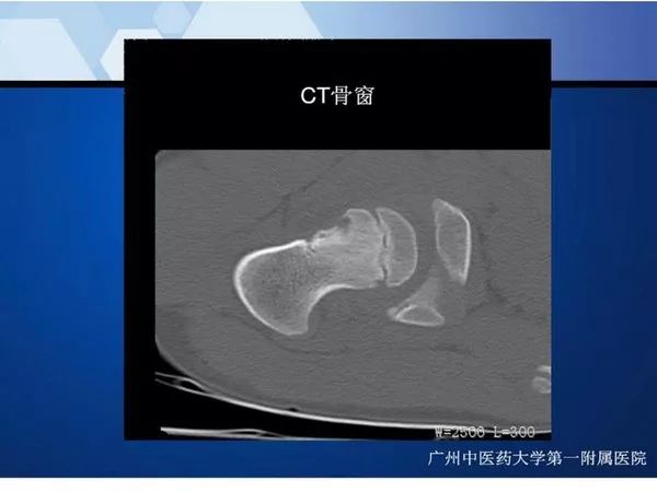 【PPT】不同部位软骨瘤影像诊断