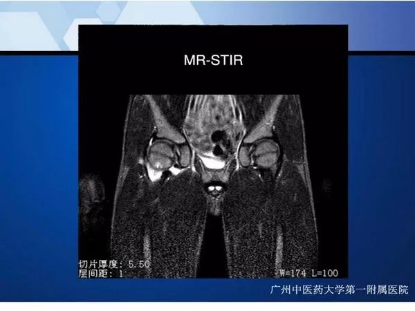 【PPT】不同部位软骨瘤影像诊断