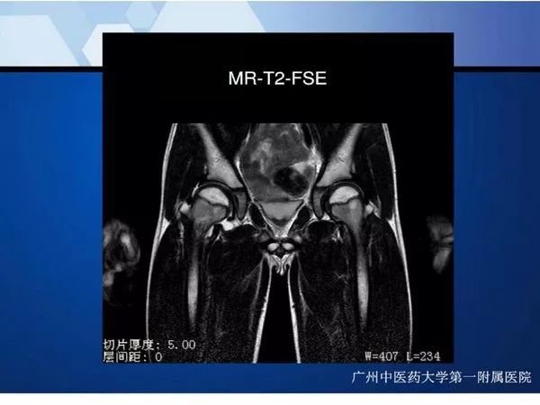 【PPT】不同部位软骨瘤影像诊断