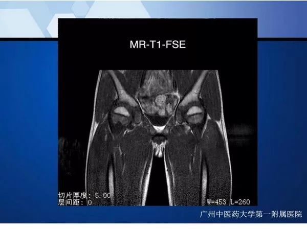 【PPT】不同部位软骨瘤影像诊断