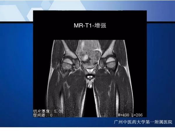【PPT】不同部位软骨瘤影像诊断