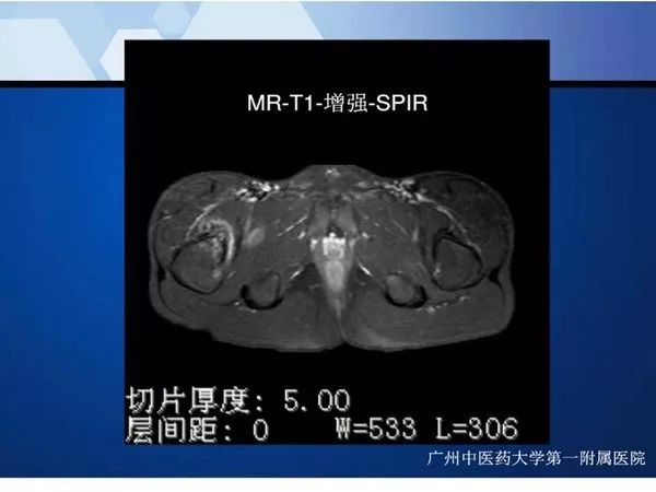 【PPT】不同部位软骨瘤影像诊断