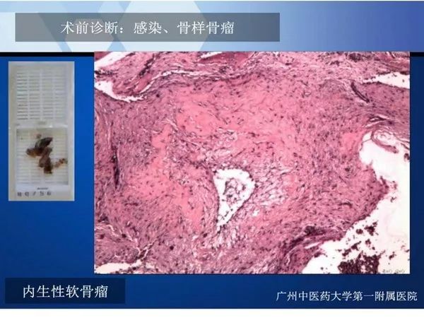 【PPT】不同部位软骨瘤影像诊断