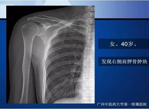 【PPT】不同部位软骨瘤影像诊断