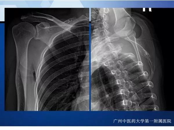 【PPT】不同部位软骨瘤影像诊断