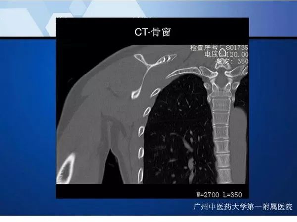 【PPT】不同部位软骨瘤影像诊断