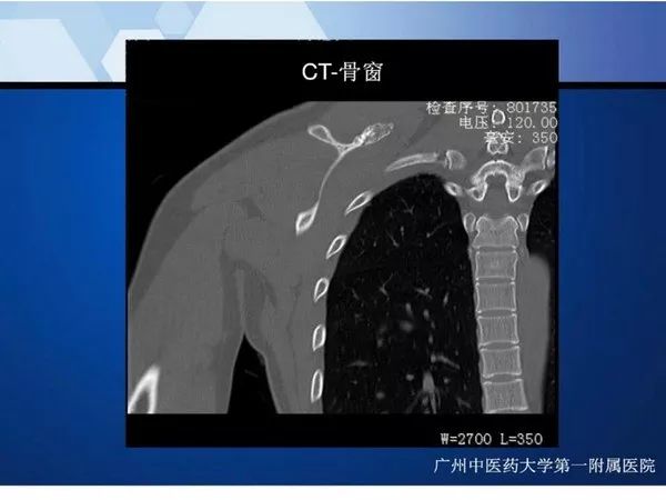 【PPT】不同部位软骨瘤影像诊断
