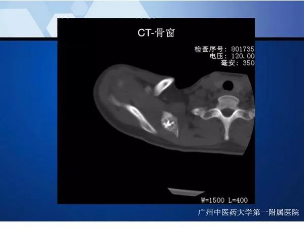 【PPT】不同部位软骨瘤影像诊断