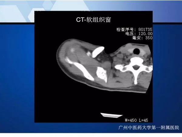 【PPT】不同部位软骨瘤影像诊断