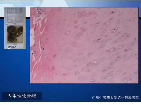 【PPT】不同部位软骨瘤影像诊断