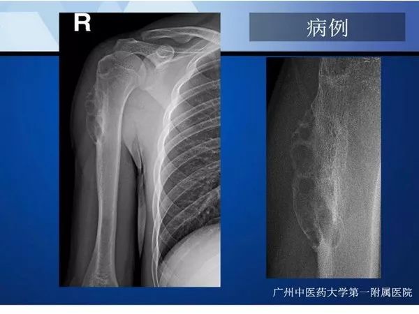 【PPT】不同部位软骨瘤影像诊断