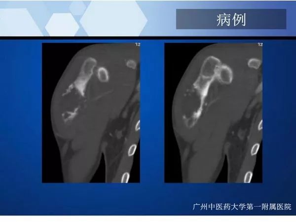 【PPT】不同部位软骨瘤影像诊断