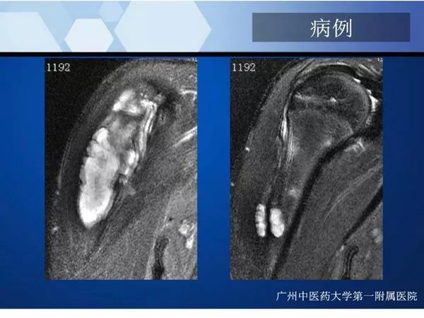 【PPT】不同部位软骨瘤影像诊断