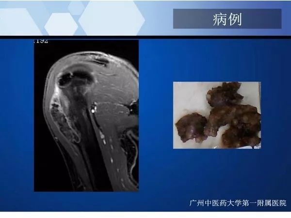 【PPT】不同部位软骨瘤影像诊断