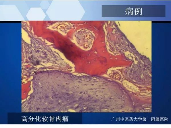 【PPT】不同部位软骨瘤影像诊断