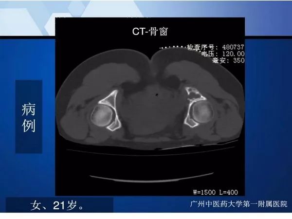 【PPT】不同部位软骨瘤影像诊断