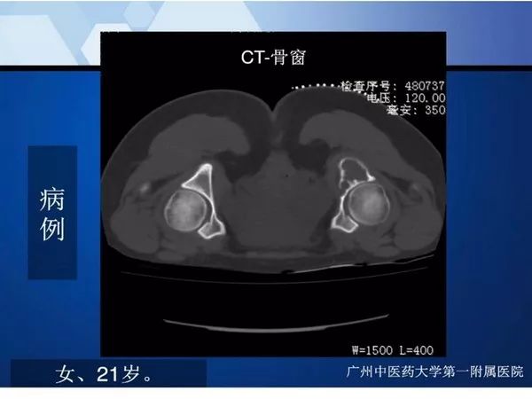【PPT】不同部位软骨瘤影像诊断