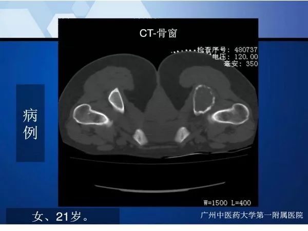 【PPT】不同部位软骨瘤影像诊断