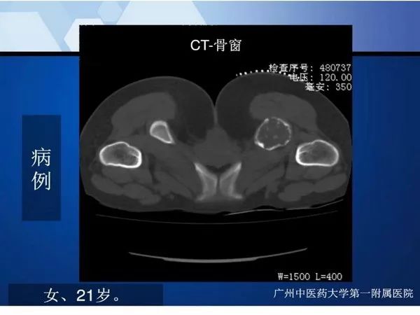 【PPT】不同部位软骨瘤影像诊断