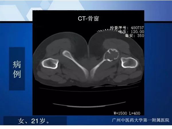【PPT】不同部位软骨瘤影像诊断