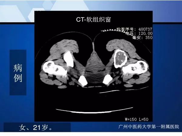 【PPT】不同部位软骨瘤影像诊断