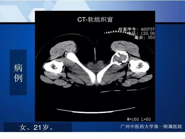 【PPT】不同部位软骨瘤影像诊断