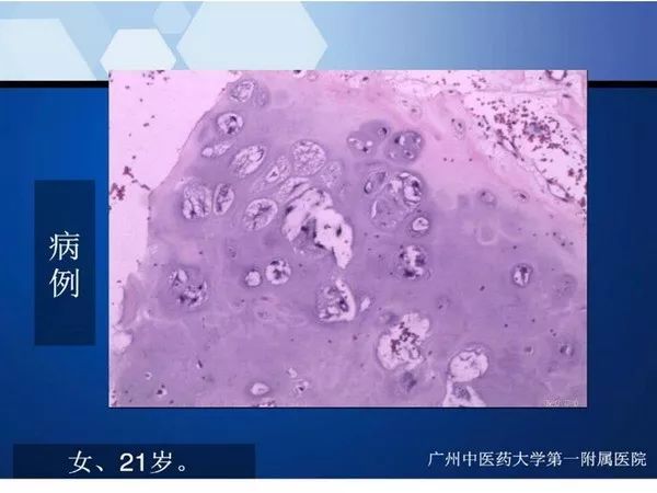 【PPT】不同部位软骨瘤影像诊断