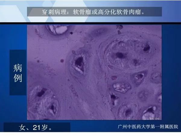 【PPT】不同部位软骨瘤影像诊断