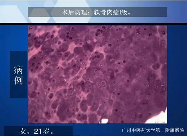 【PPT】不同部位软骨瘤影像诊断