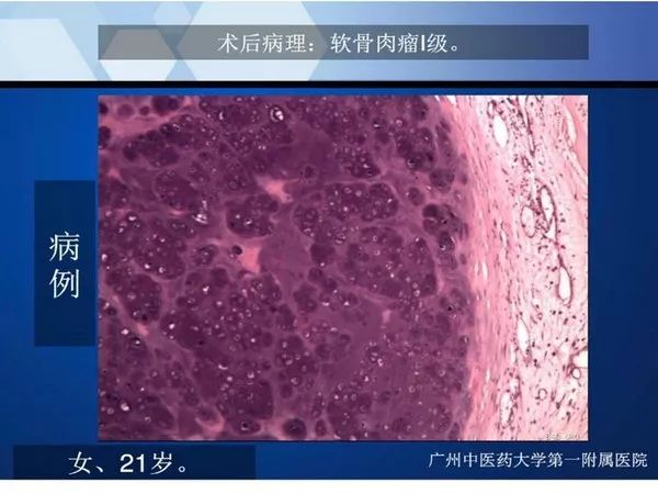 【PPT】不同部位软骨瘤影像诊断