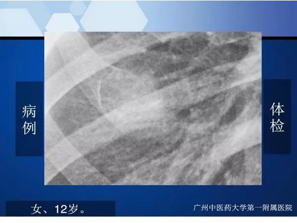 【PPT】不同部位软骨瘤影像诊断