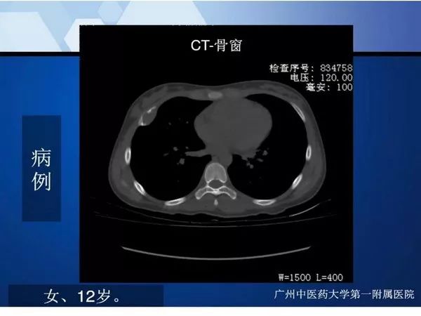 【PPT】不同部位软骨瘤影像诊断