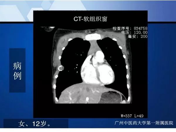 【PPT】不同部位软骨瘤影像诊断