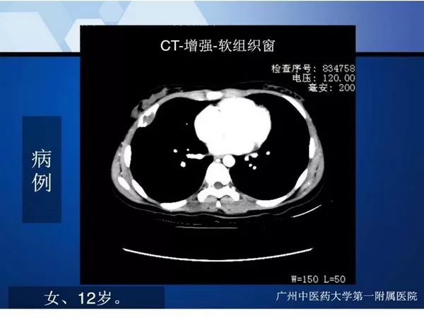 【PPT】不同部位软骨瘤影像诊断