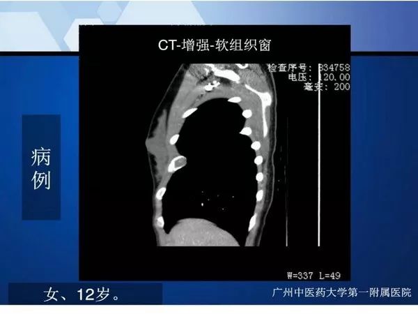 【PPT】不同部位软骨瘤影像诊断
