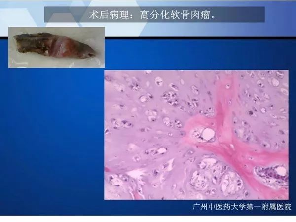 【PPT】不同部位软骨瘤影像诊断