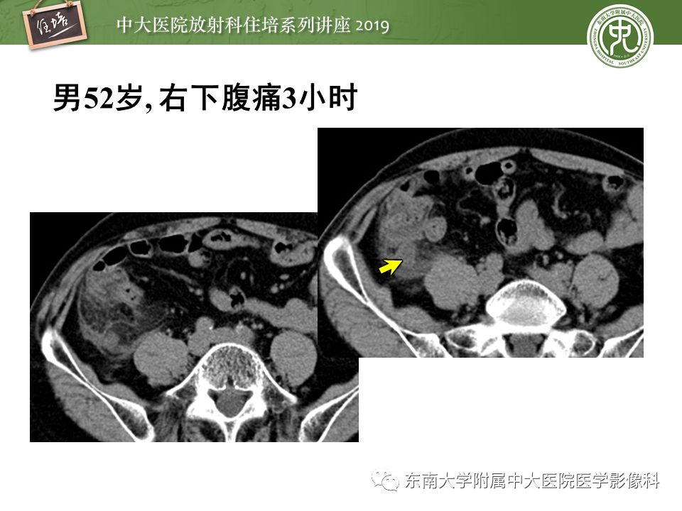 【PPT】肠道急腹症的影像诊断